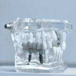 Implanty dentystyczne – plusy i minusy